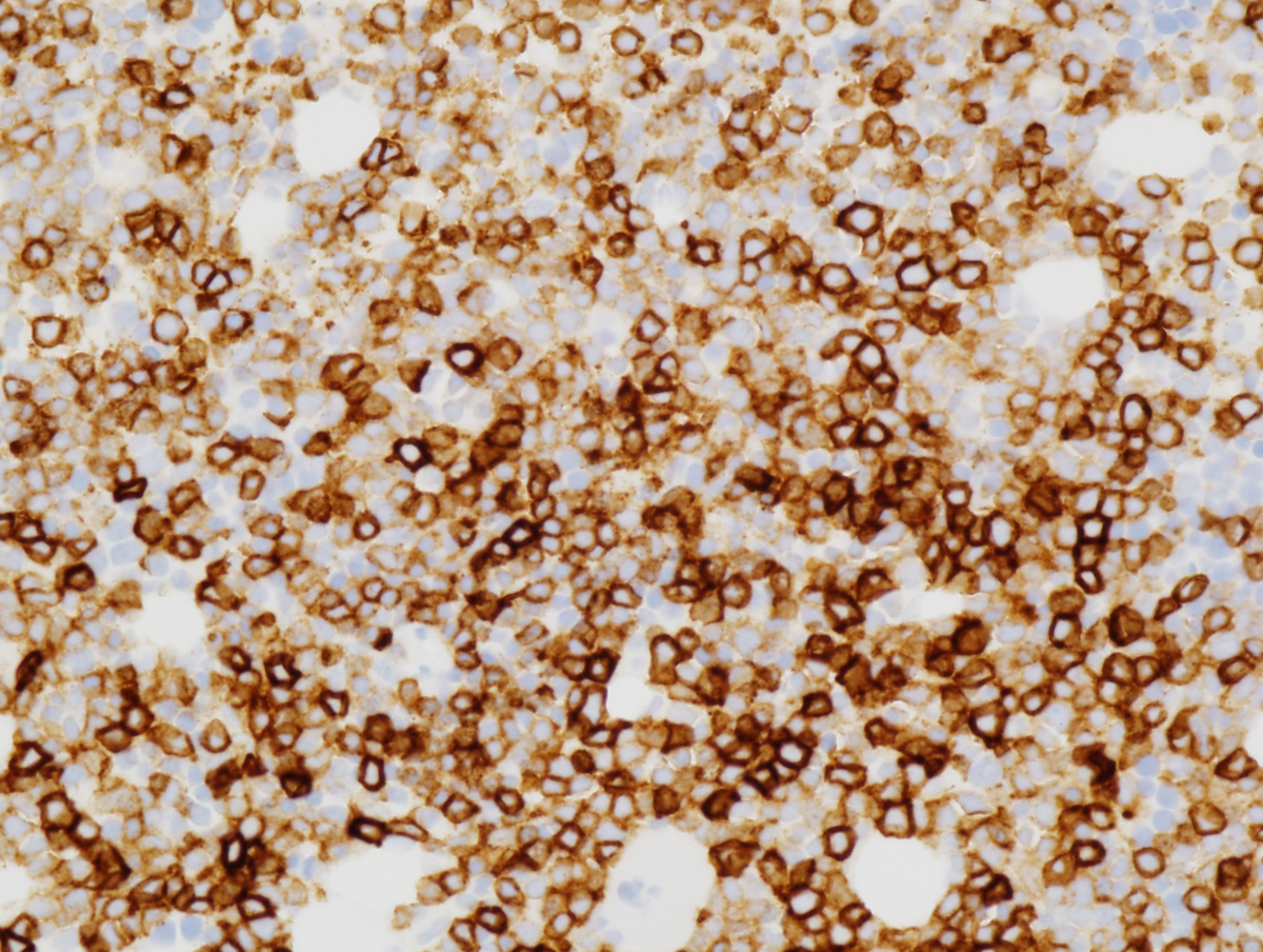 Figure 5(CD7): Immunohistochemistry of bone marrow clot sections (400x magnification).